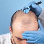 trasplante de cabello, especialista marca la zona de las entradas de cabello a hombre calvo que necesita el procedimiento capilar