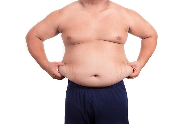 cáncer de mama en hombres - hombre obeso con ginecomastia 