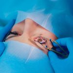 cirugía láser refractiva - Operación de ojo con tecnología laser de punta