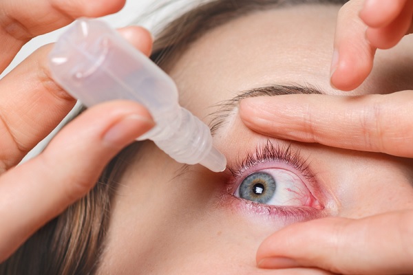 mujer vierte gotas en sus ojos que estan secos, como efecto secundario de la cirugía oftálmica