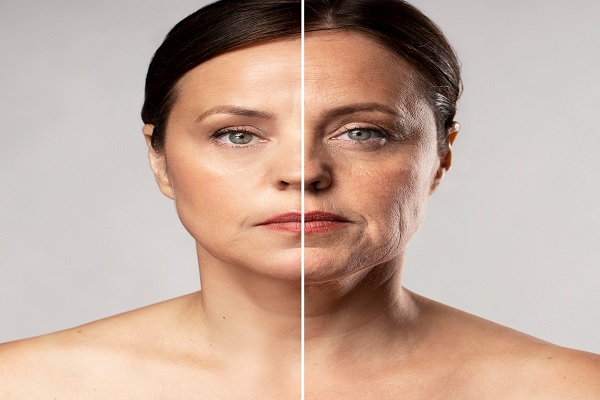 rellenos faciales - antes y después de retoques con relleno facial, de una mujer madura